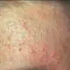 青春痘粉刺