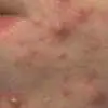 青春痘粉刺