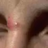青春痘粉刺