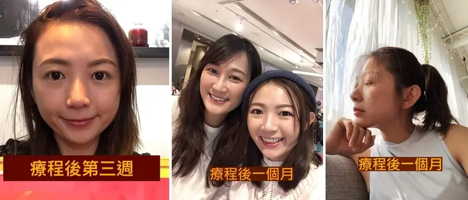 凱西 : 除了瑜珈運動之外的醫美保養之路－第一次嘗試音波拉提＋玻尿酸填補