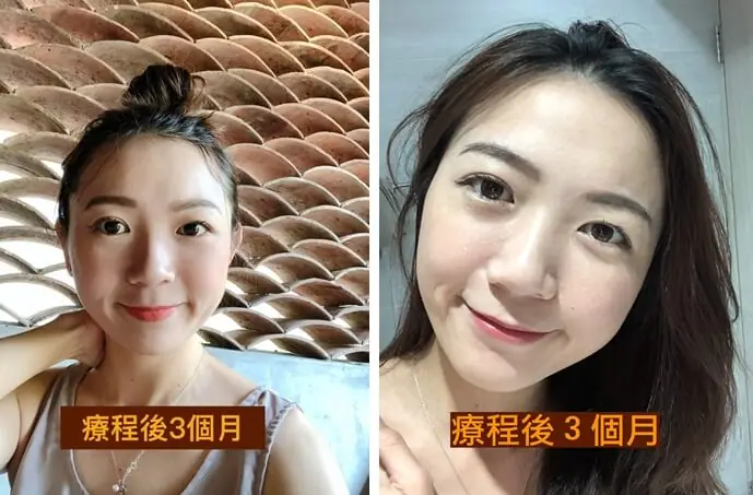 凱西 : 除了瑜珈運動之外的醫美保養之路－第一次嘗試音波拉提＋玻尿酸填補