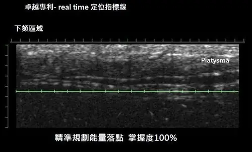 Ulthera極線音波拉提的使用心得分享