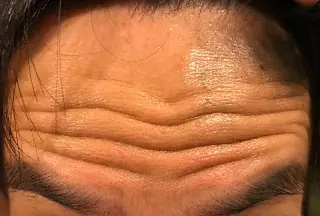音波拉提可以取代肉毒治療嗎?