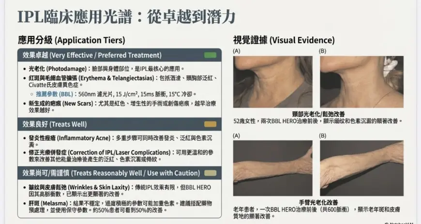 關於脈衝光(IPL)你不知道的5個驚人事實：從意外發現到逆轉肌膚基因