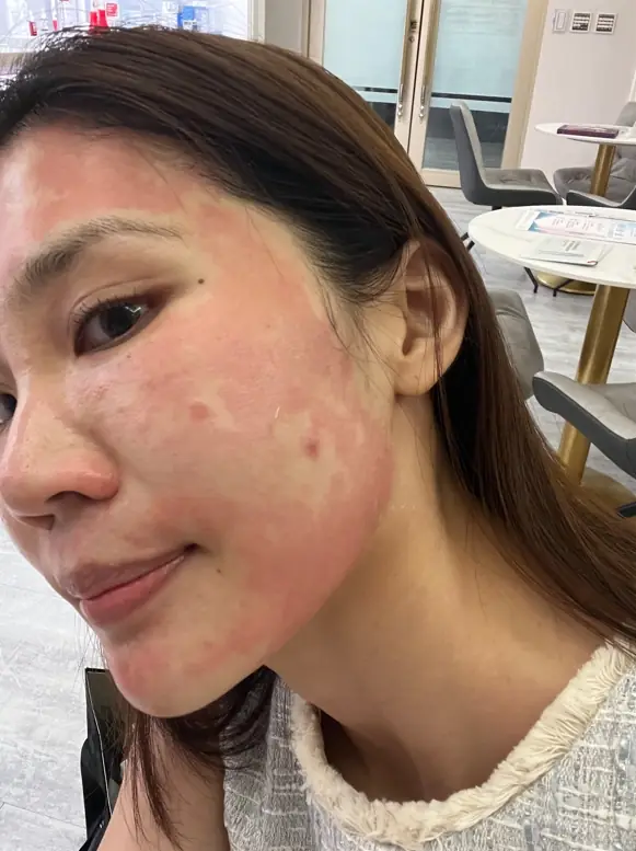 Chloe：突破保養停滯期！打造細緻勻亮好膚質︱得美微針筆